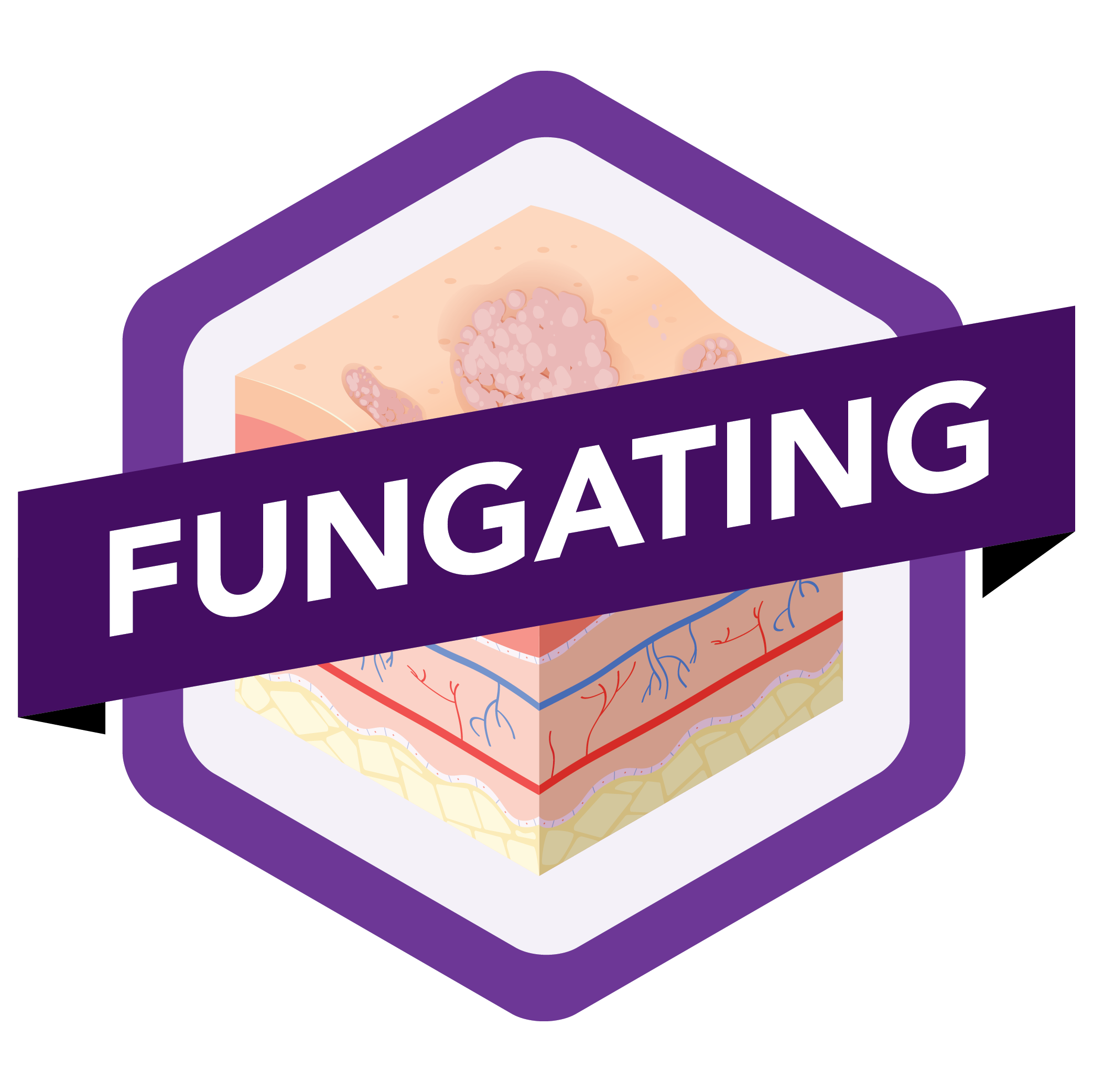 Fungating